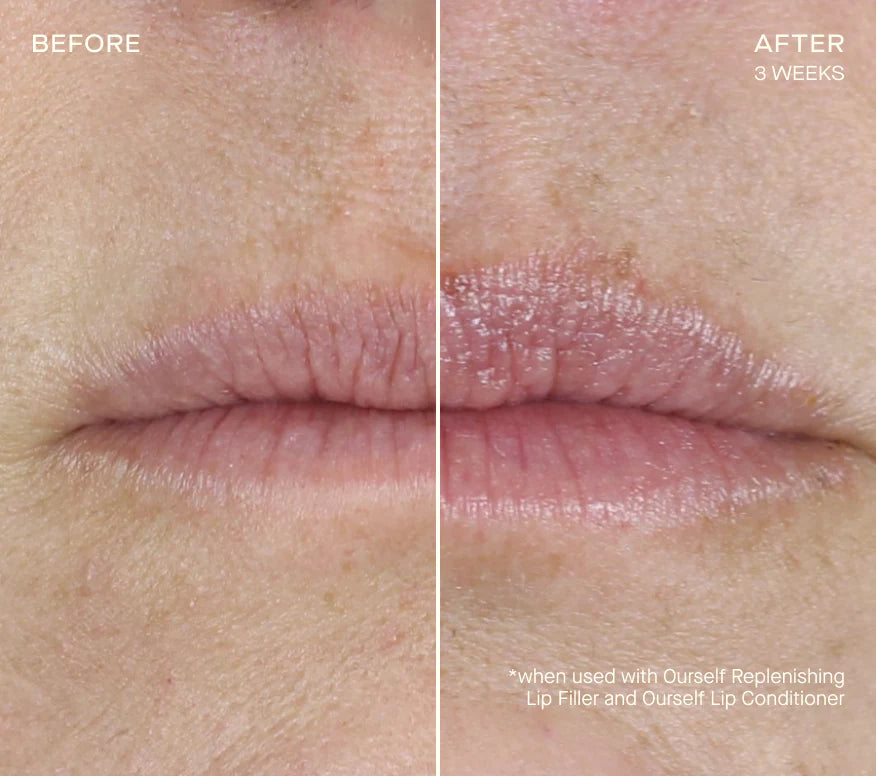 Replenishing Lip Filler with Tiered-Release Vesicle Delivery Technology™
