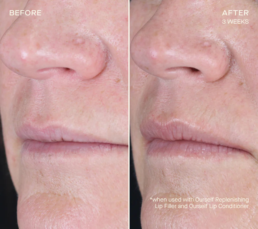 Replenishing Lip Filler with Tiered-Release Vesicle Delivery Technology™
